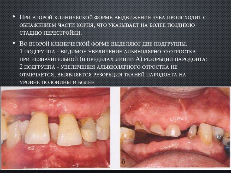 При второй клинической форме выдвижение зуба происходит с обнажением части корня, что указывает на